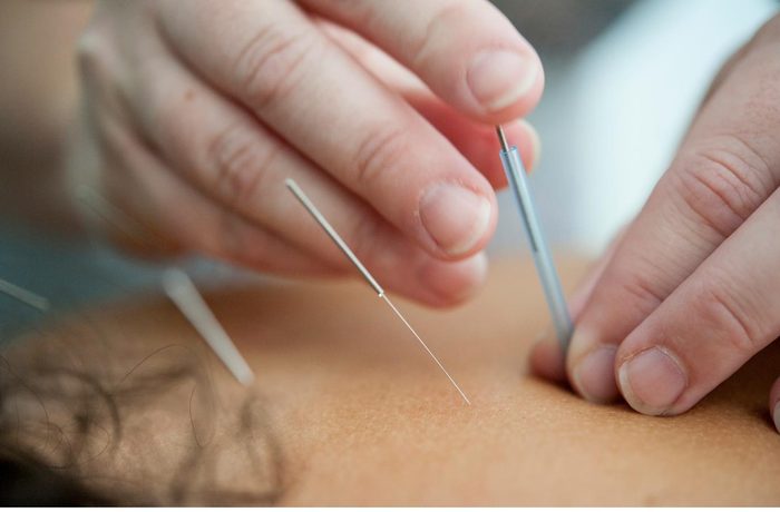Acupuncture treatment being applied to a patient